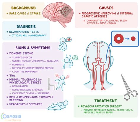 Moyamoya Disease: What Is It, Signs, Treatment, and More