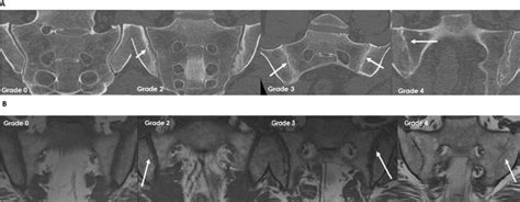 Radiography, abdominal CT and MRI compared with sacroiliac joint CT in ...