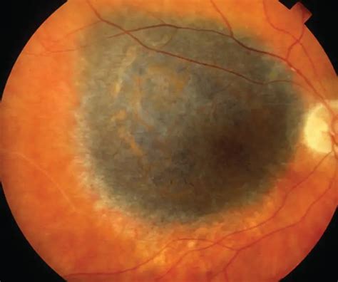 Choroidal melanoma - American Academy of Ophthalmology