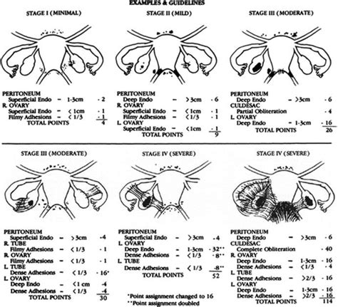 Endometriosis Stages - Endometriosis Stages And How They Are Measured ...