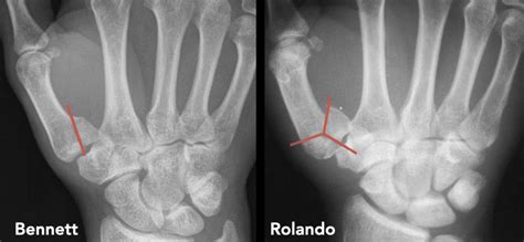 Rolando fracture • LITFL • Medical Eponym Library