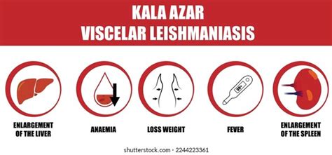 Kala Azar Symptoms Viscelar Leishmaniasis Disease Stock Vector (Royalty ...