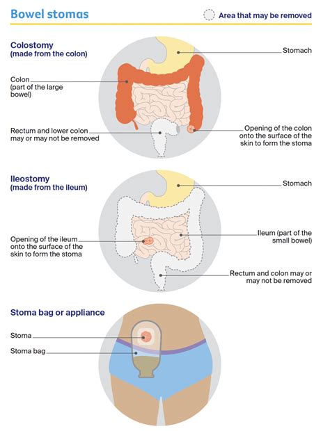 Share 135+ colostomy bag removal surgery super hot - 3tdesign.edu.vn