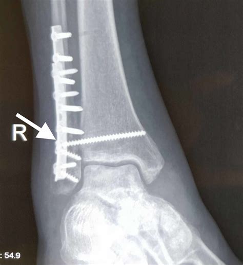 Fracture fibula - lopersthebig