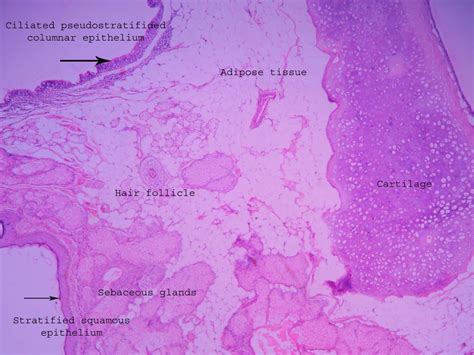 Dermoid cyst – ovary – Histopathology.guru