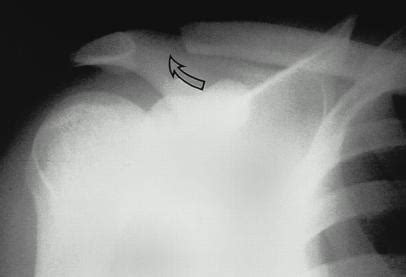 AC Joint Arthritis « LA Shoulder