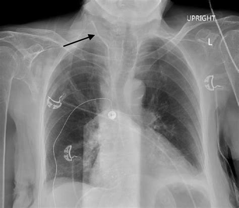 Cureus Subclavian Artery Injury Following Central Venous Catheter | The ...