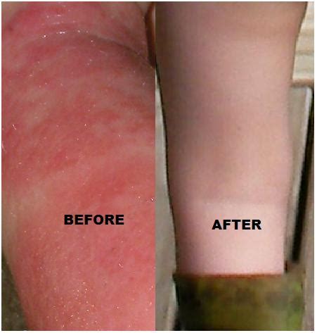 Eczema - Natural Healing Centre