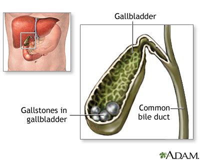 Gallstones: MedlinePlus Medical Encyclopedia