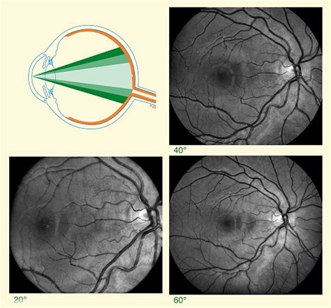 Fundus Photography Overview - Ophthalmic Photographers' Society