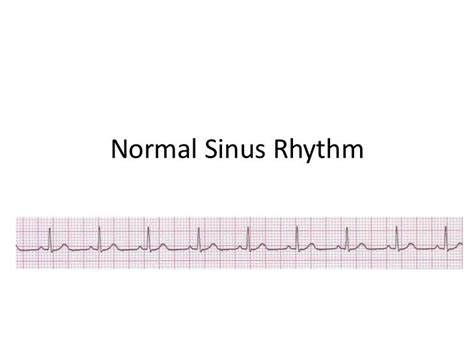 Normal sinus rhythm