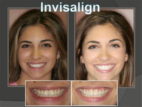 Invisalign Before And After Face Shape | Before And After