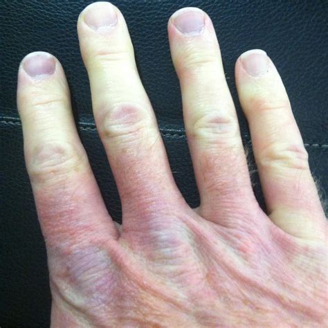 Raynaud syndrome - Wikipedia