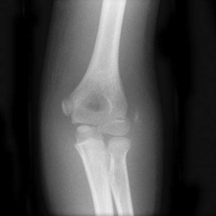 Lateral Epicondyle Fracture