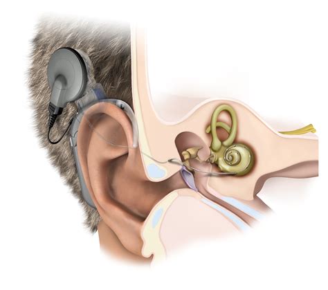 Auditory Brainstem and Cochlear Implants | Health&Fitness Talk