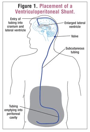 Review of the Treatment & Management of Hydrocephalus