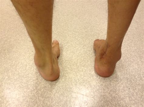 Foot Deformities Singapore|Surgery Reconstruction|Correction