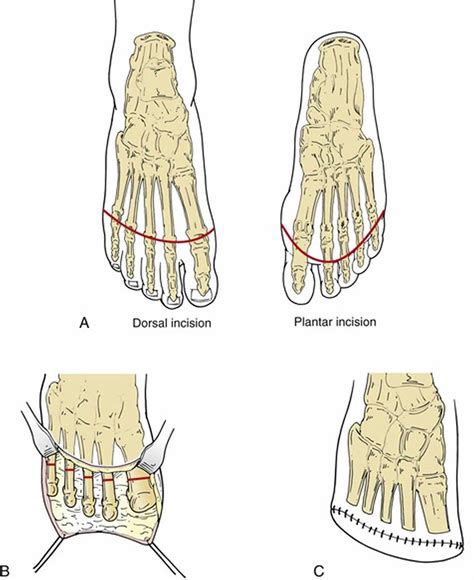 Amputation causes, types of amputation and amputation complications