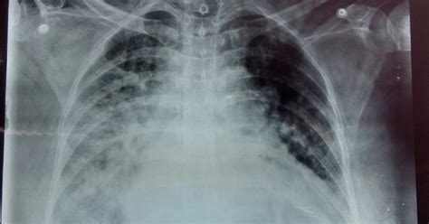 Pulmonary Edema Vs Normal Chest X Ray