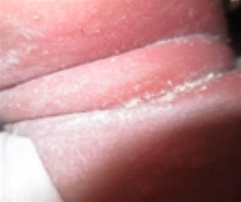 Intertrigo: Pictures, Rash, Symptoms, Causes, Treatment - HubPages