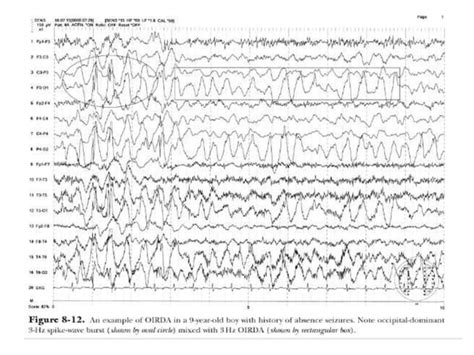 Recognition of abnormal EEG.