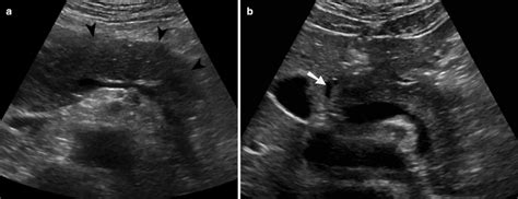 Imaging of Acute Pancreas | Radiology Key