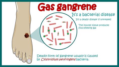 Gas Gangrene | Clostridial Myonecrosis | Symptoms and treatment of Gas ...