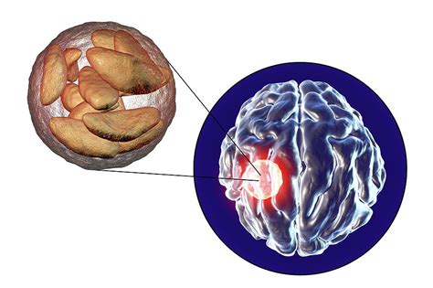 Brain Abscess Caused By Toxoplasma Gondii Photograph by Kateryna Kon ...