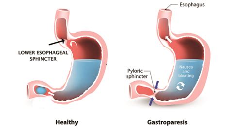 GASTROPARESIA PDF