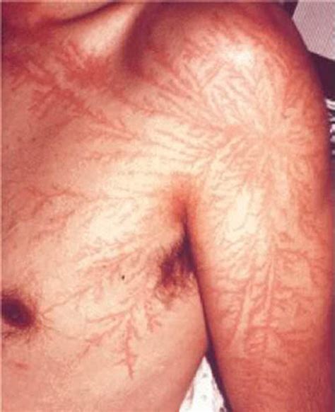 Lichtenberg Figures: The Fractal Patterns of Lightning Strike Scars ...