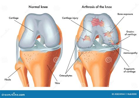 Arthrosis of the knee stock vector. Illustration of fragments - 45824944