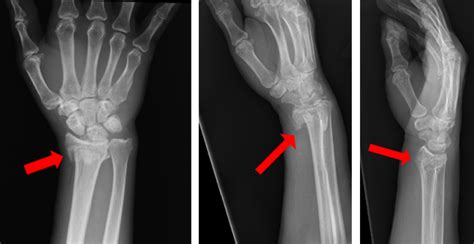 X Ray Of Human Hand With Broken Wrist Fracture Of Radius