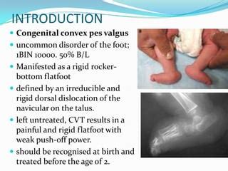 Congenital vertical talus UG lecture | PPT