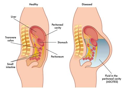 What is Ascites?