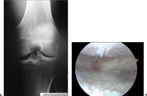 Arthroscopic Debridement of the Knee | Musculoskeletal Key