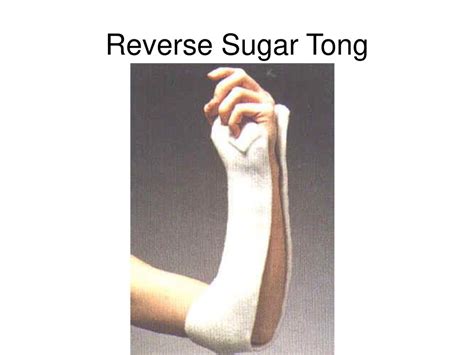 Reverse Sugar Tong Splint