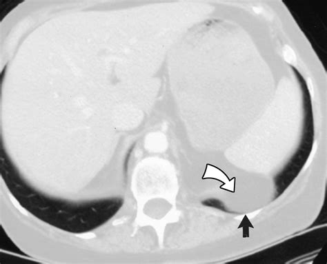 Prevalence of Incidental Bochdalek's Hernia in a Large Adult Population ...