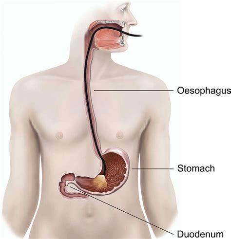 Lower Endoscopy Procedure