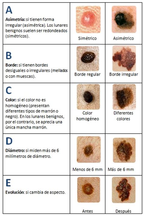 Claves para la detección precoz del melanoma: Sistema ABCDE - Blog de Salud