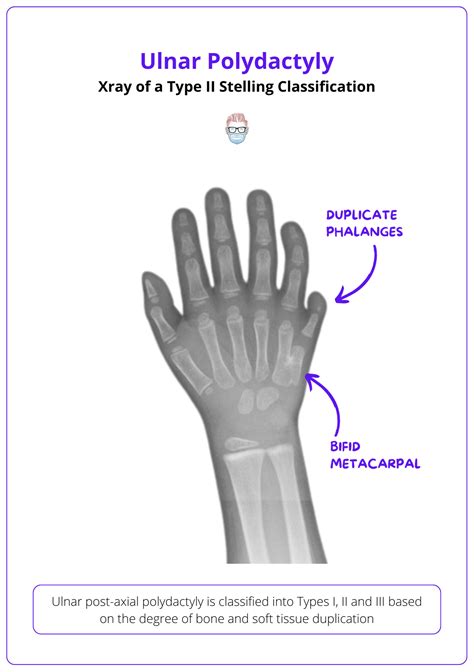 Polydactyly: Classification & Treatment