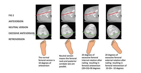 Second-generation locked nails help avoid rotational malalignment in ...