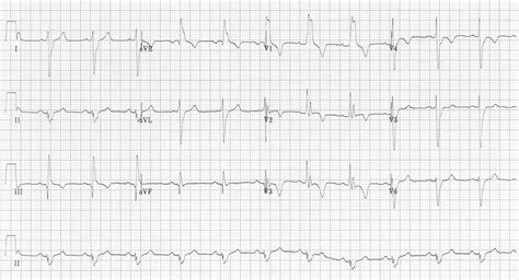 Ecg Changes In Pulmonary Embolism • Litfl • Ecg Library CB9