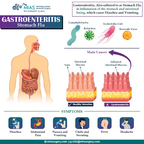 Gastroenteritis Complete Guide : Causes, Symptoms & Treatment