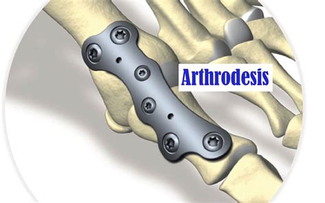 Arthrodesis definition & procedure - Consulting Footpain