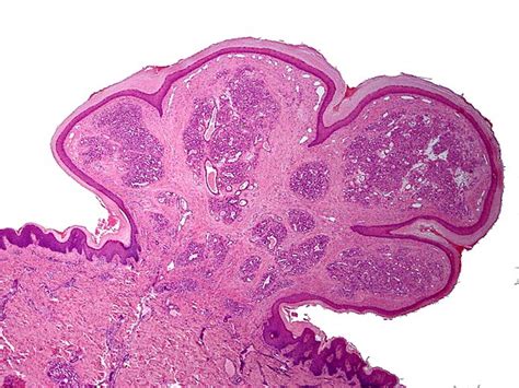 Lobular capillary hemangioma - Libre Pathology