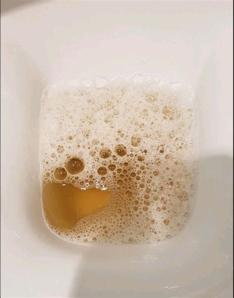 Bubbles In Urine