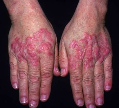 Lupus - Systemic Lupus Erythematosus (SLE) - Causes, Sign & Symptoms