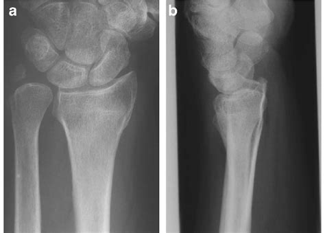 ランキング1位獲得 Distal Radius Fractures and Carpal - 【当店人気★送料無料】 - www ...