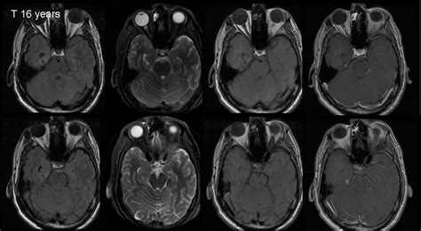 Ganglioglioma