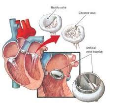 Prosthetic Heart Valves – Pipeline Market Review 2015 | Global Clinical ...